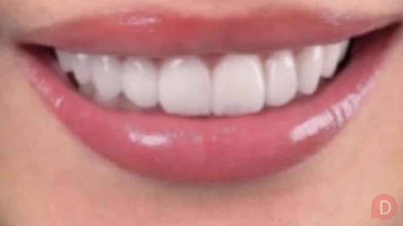 Керамические виниры высочайшего качества в Екатеринбурге Екатеринбург - изображение 1